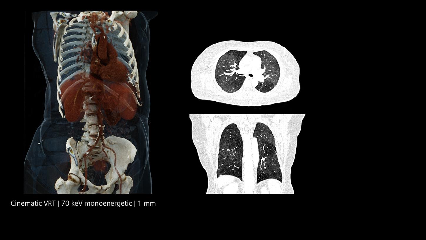 Incidental finding case of CTEPH in tumor localizer exam: Quantum Spectral imaging reveals perfusion defects, cVRT image, 70 keV, 1 mm