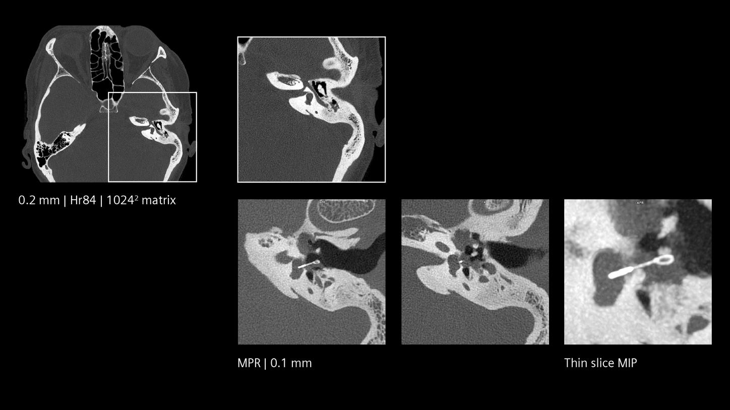 Quantum HD imaging of skull-base for implant follow-up.