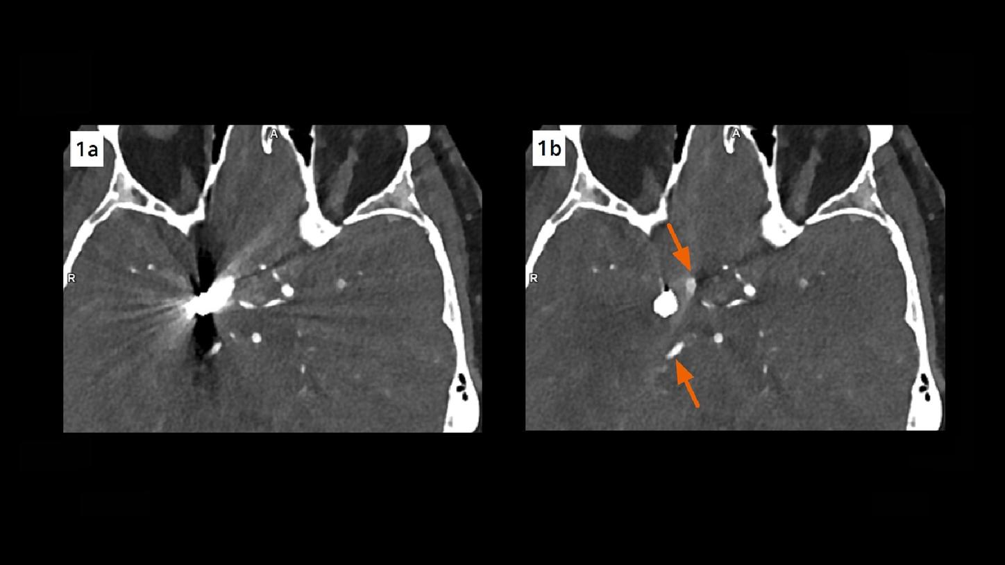 An axial image prior to iMAR shows an obscured visualization of the embolized aneurysm and the adjacent arteries due to artifacts. The visibility is clearly improved in the image reconstructed with iMAR.