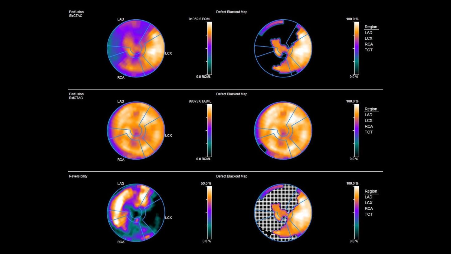 Polar maps of PET stress cardiac attentuation correction (AC) static, PET rest cardiac AC static, and reversibility.