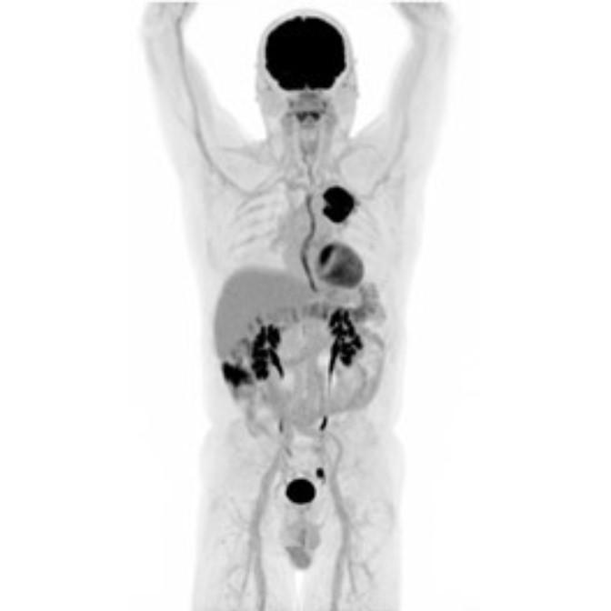 Oncology Indications Lung