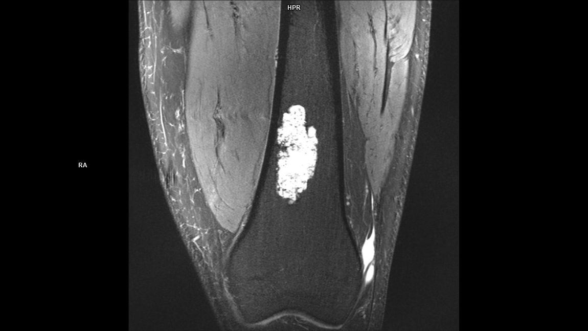 Coronal PD FS-MAGNETOM Terra/Coil-Knee/Resolution-432/Scan Time-3:00/Aceleration-p2