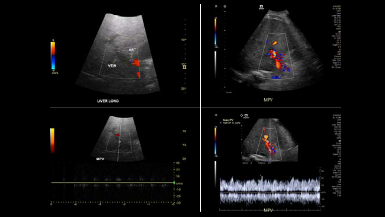 Portal vein evaluation with DAX