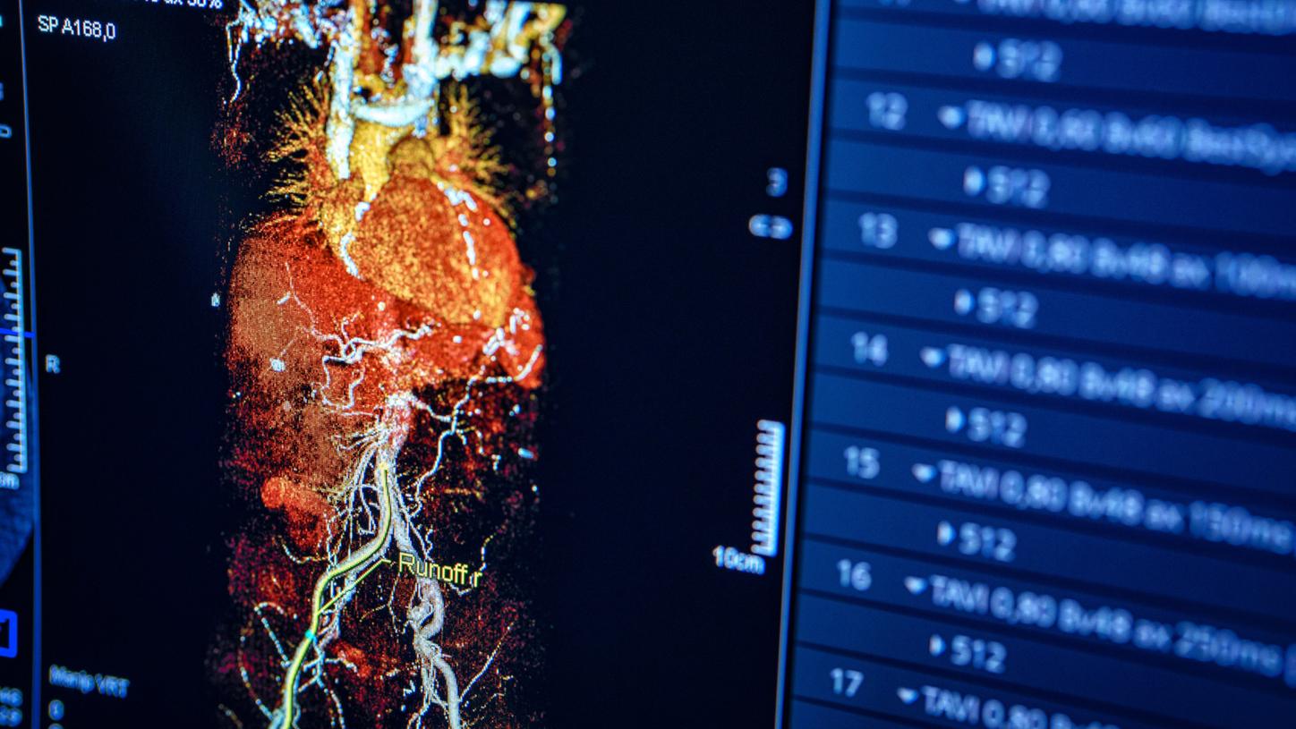 3D medical scan showing heart and blood vessels on a monitor.