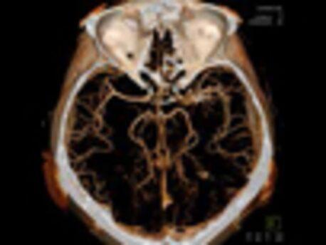 Follow-up after stent-assisted aneurysm coiling