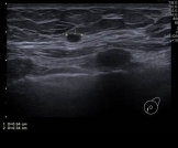 Image C: Ultrasound image of a similar-appearing mass in the lower inner left breast.