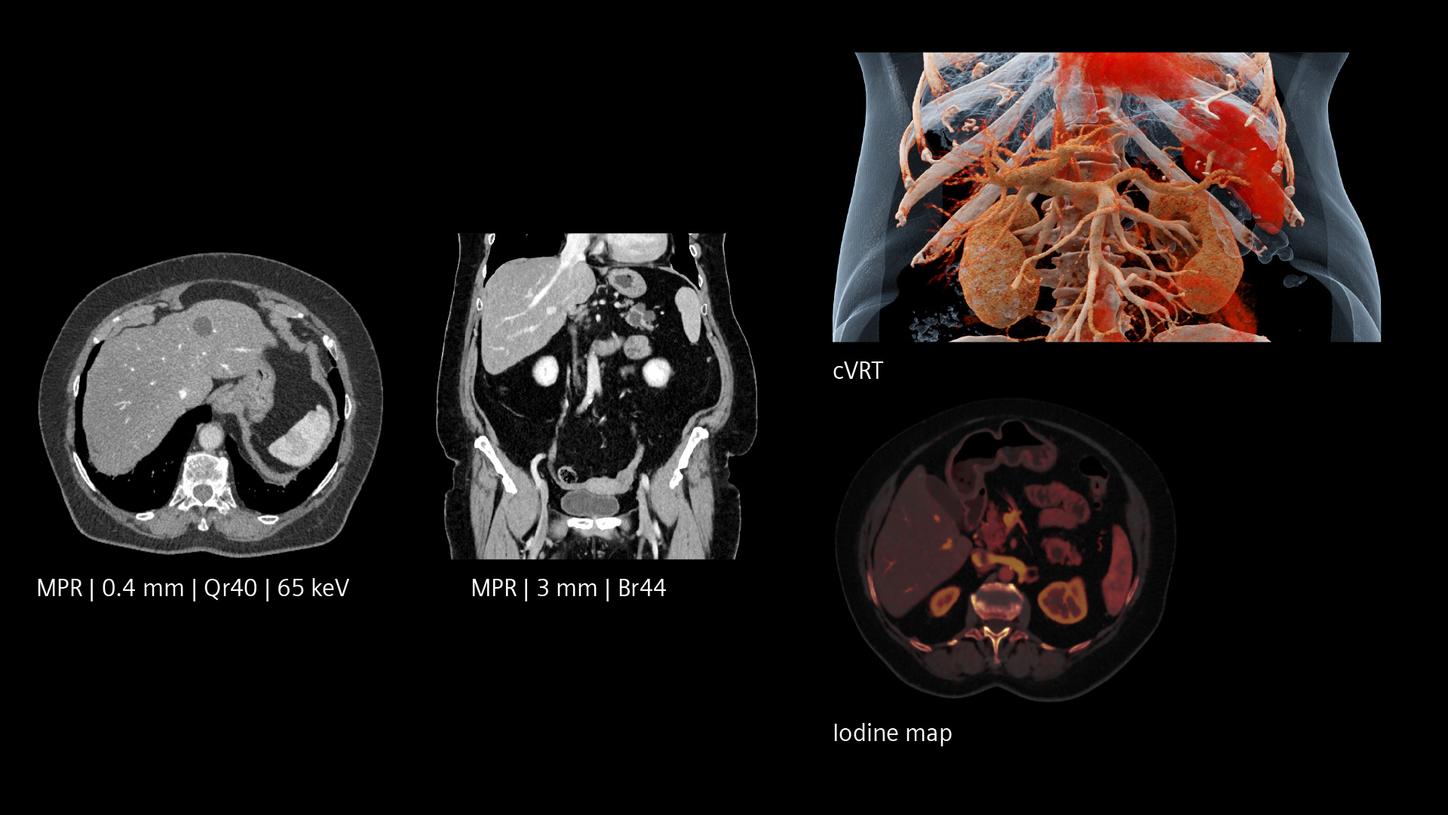 Liver lesion on a patient with high BMI