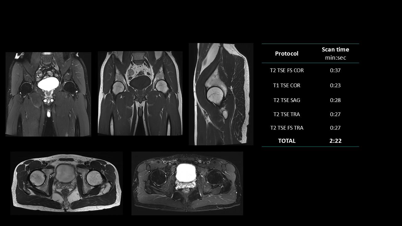 siemens-healthineers_magnetomworld_Hip-rountine.