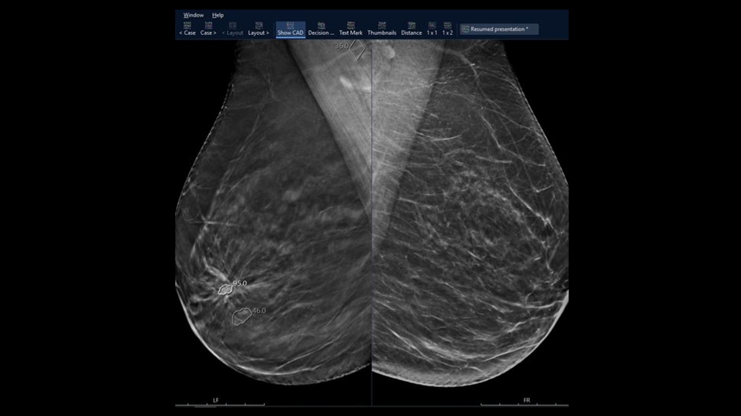 Screenshot of a mammography image