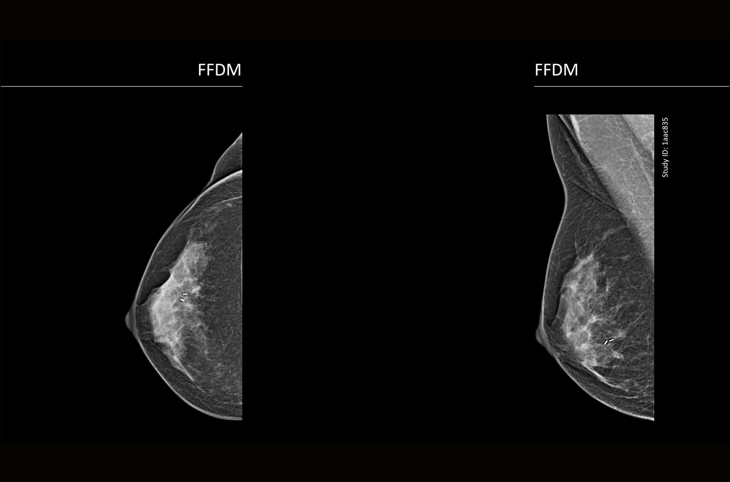 CT image of retro-ocular masses causing exophthalmos along with bilateral perinephric, pericardial, and pelvic exudates