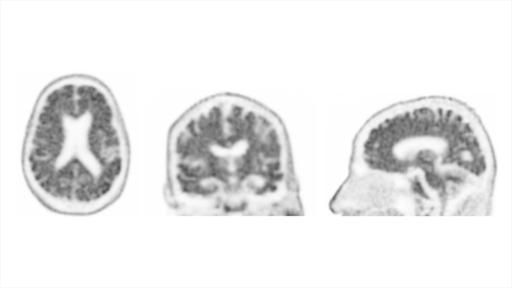 Beta-amyloid PET/CT imaging in the assessment of memory loss and ...