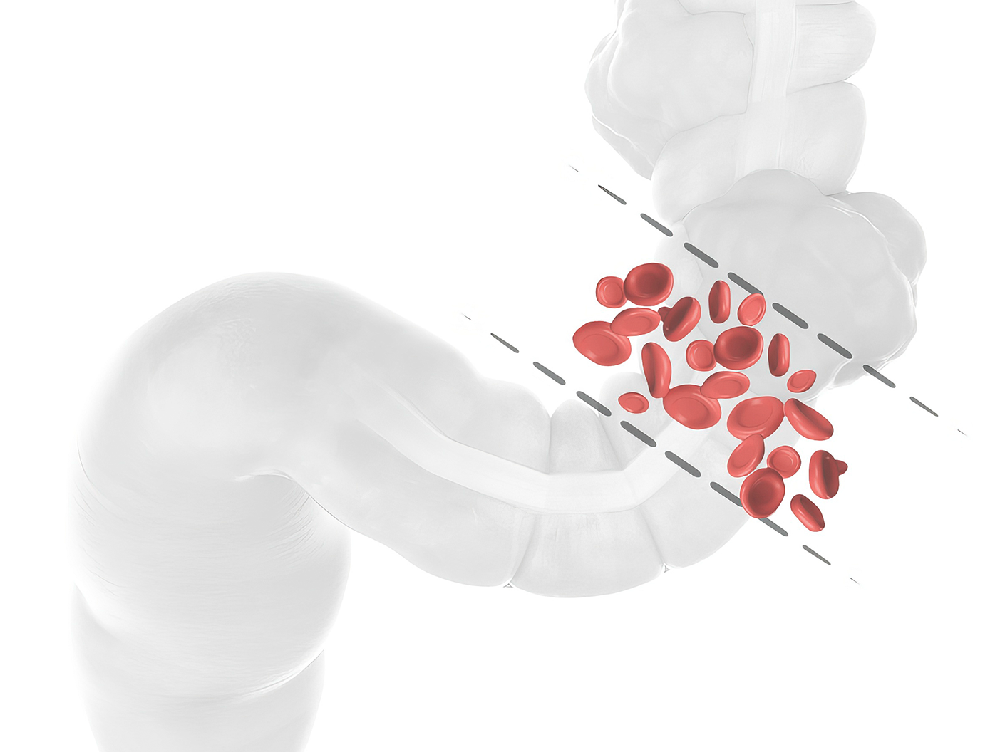  Fecal Occult Blood Testing Colorectal Cancer Screening