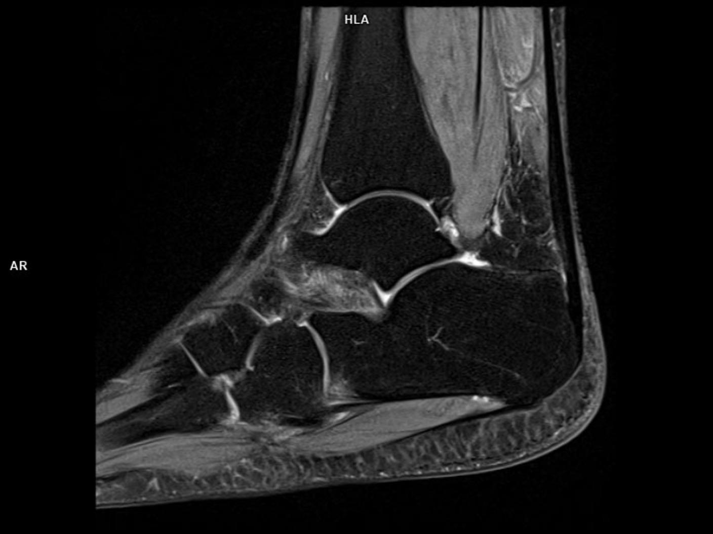 Sagittal PD FS-MAGNETOM Lumina