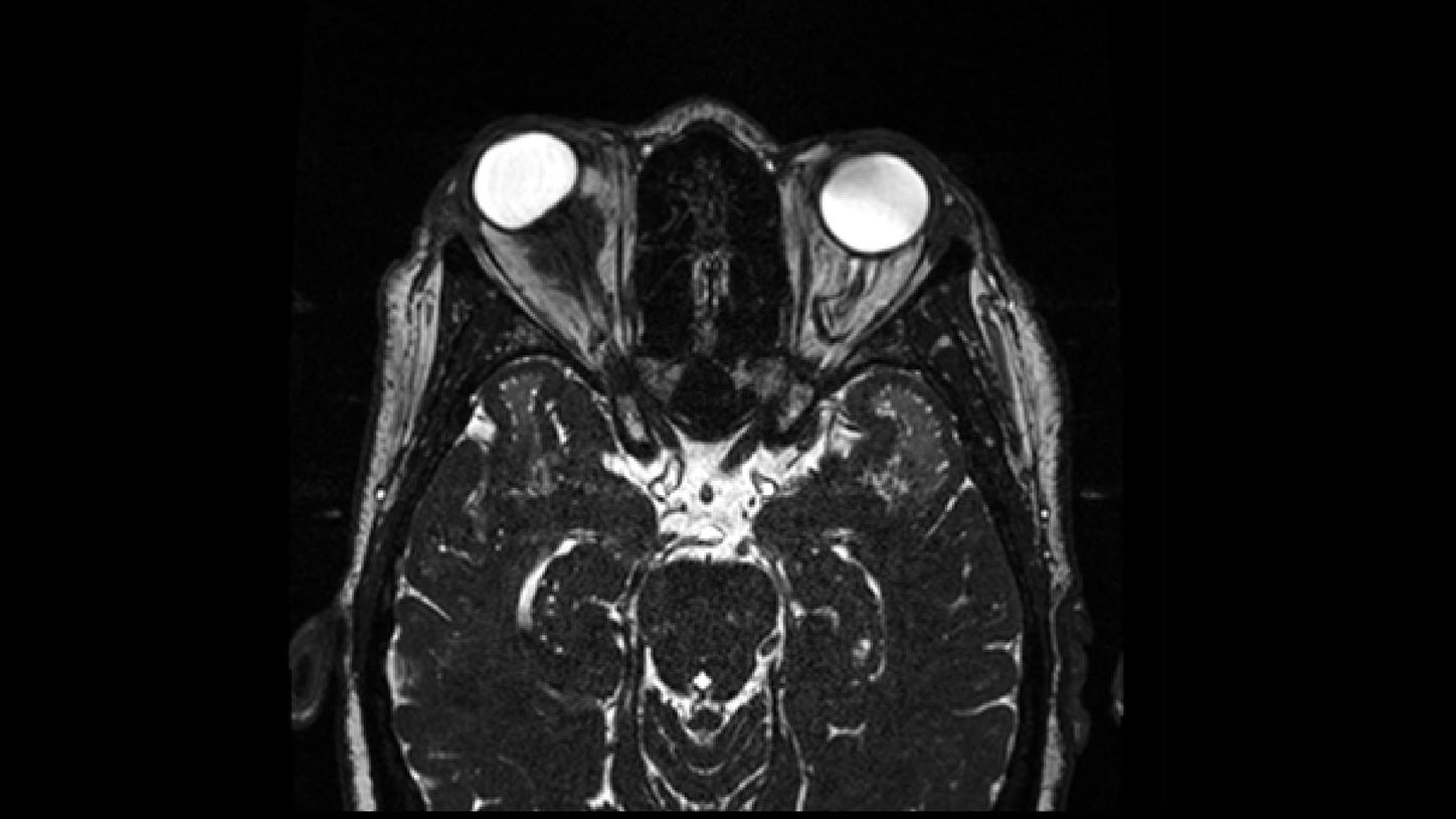 meningioma óptico