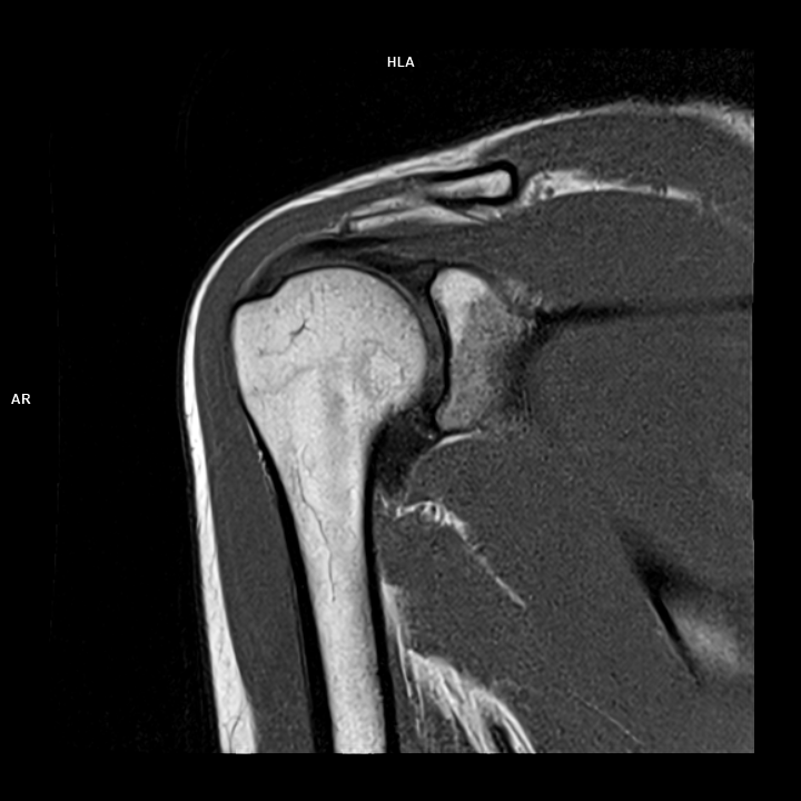 Coronal T1-MAGNETOM Free.Max/Coil-Contour Small/Resolution-512/Scan Time-4:24/Aceleration-DRS