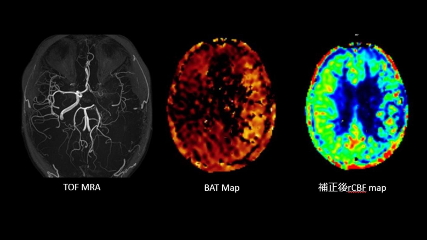 血流情報の個人差や病態差を補正し、脳血流量をより正確に評価する Multi ASL
