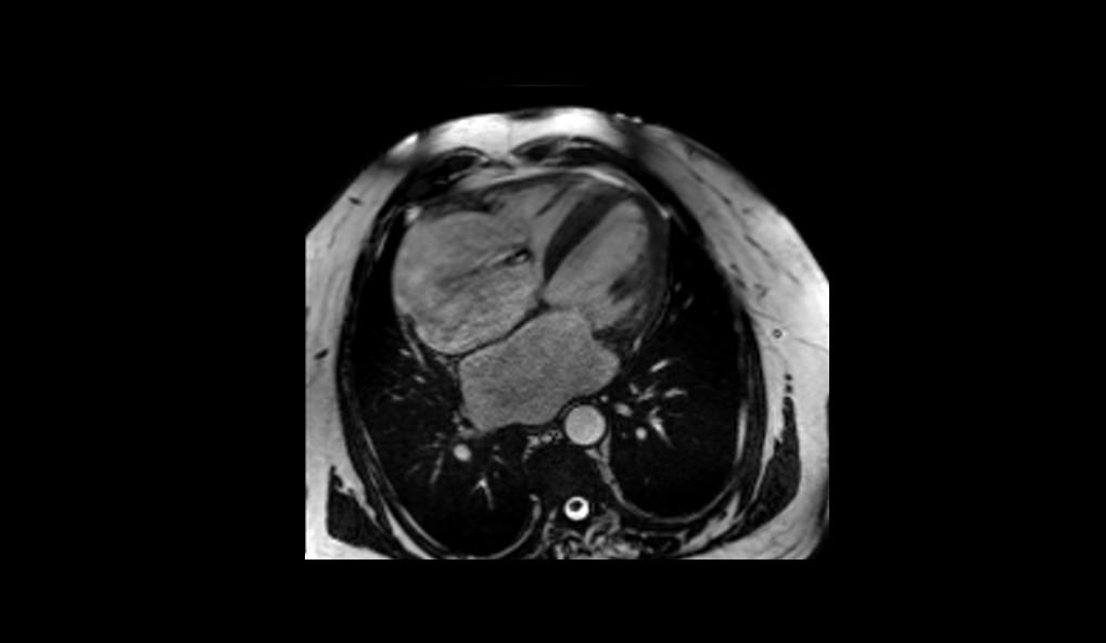 Imágen 1 de Caso Cardiomiopatía diltada 