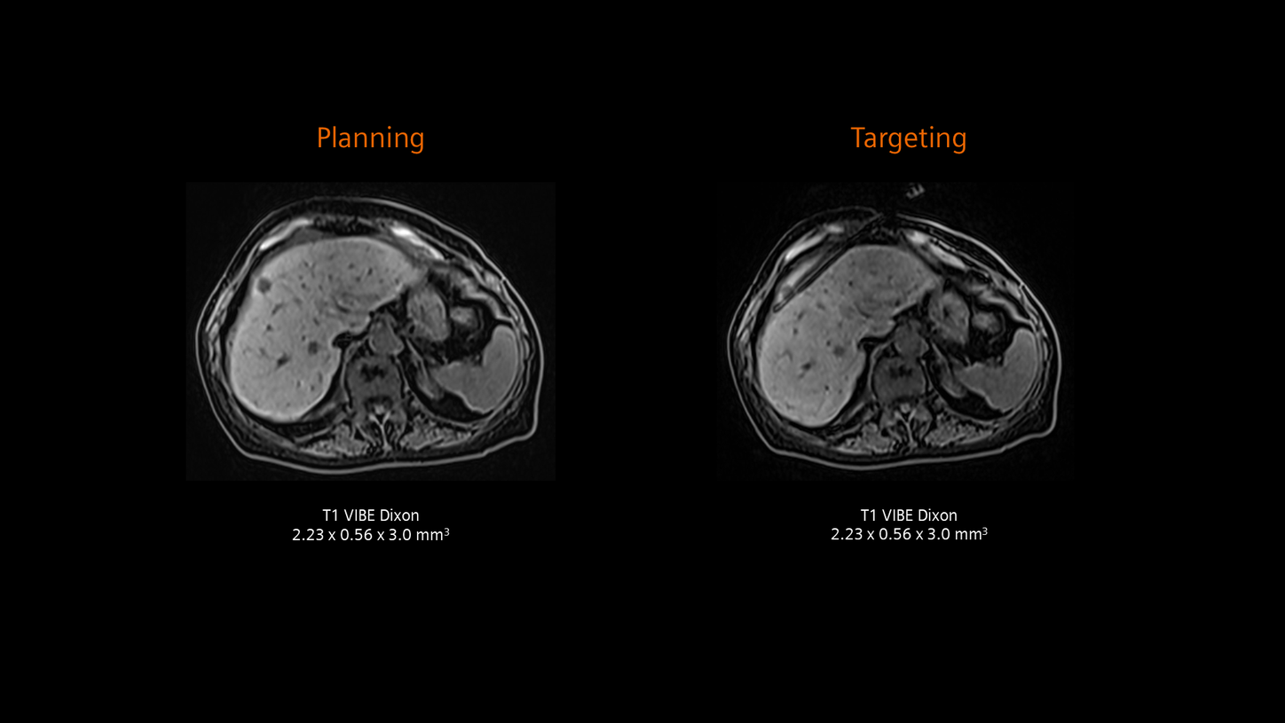 Biopsy of a liver metastasis (MAGNETOM Free.Max)