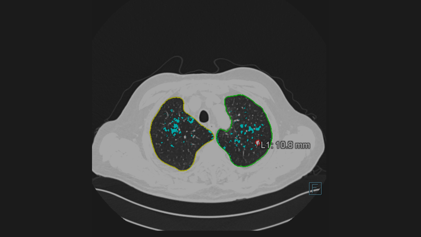 AI-Rad Companion Lungs