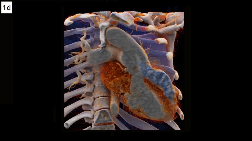 Unrepaired persistent truncus arteriosus in an adult - Siemens ...