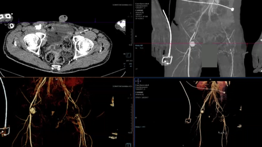 The role of CT 3D Visualization on vascular imaging - Siemens ...