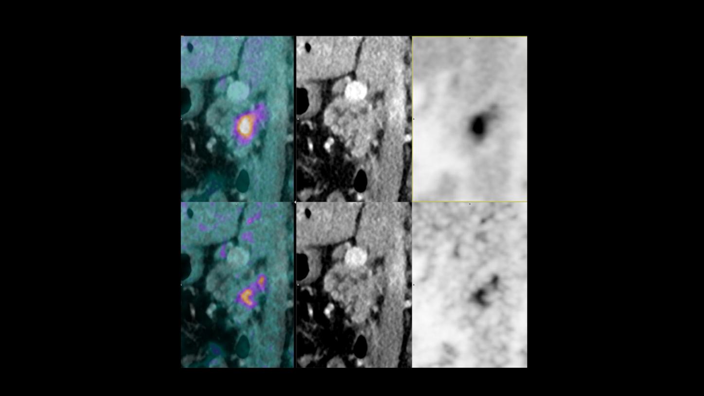 Pancreatic cancer, staging workup; FlowMotion AI (continuous bed motion).