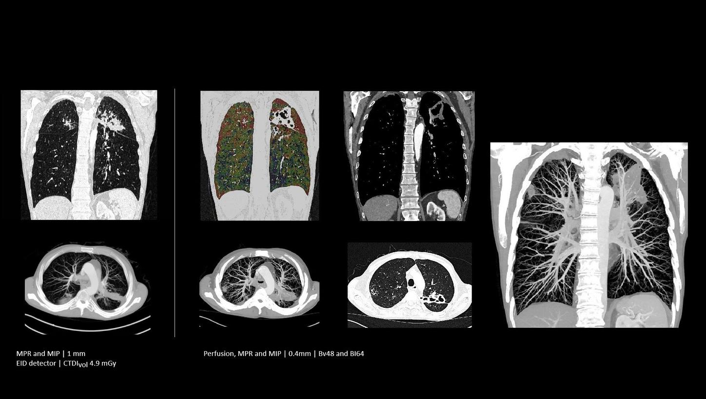CM enhanced lung scan for follow-up 