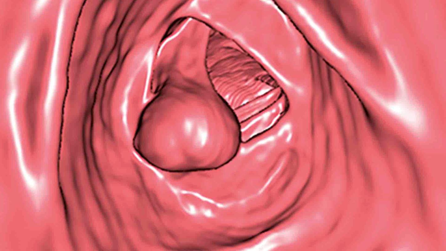 CT Colonography with syngo.via