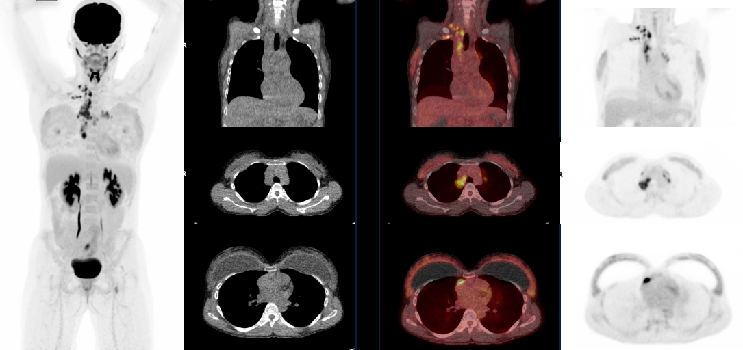 PET/CT in pregnant patients