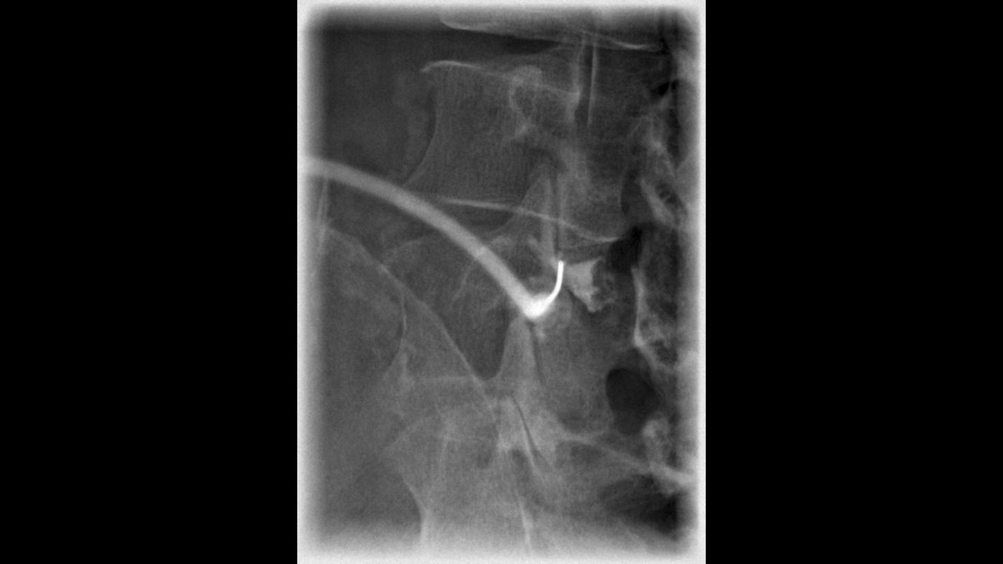 DI XP Luminos Qnamix Facet infiltration