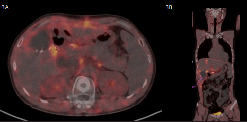 Fig 3A & 3B: A re-excision of the positive liver bed margin and regional lymph node sampling.