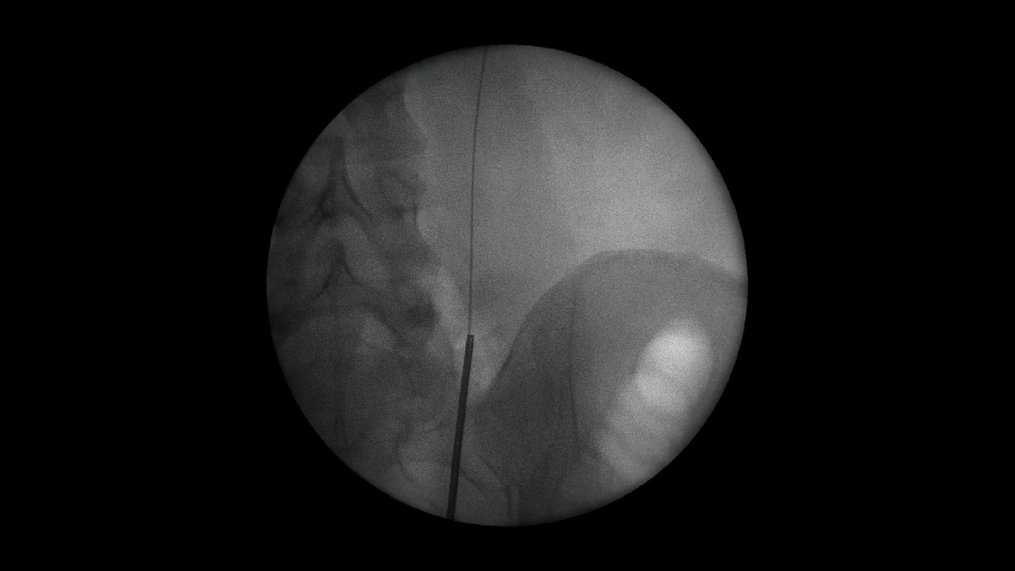 Catheter and guidewire with Cios Fit, a mobile 2D C-arm for surgery.