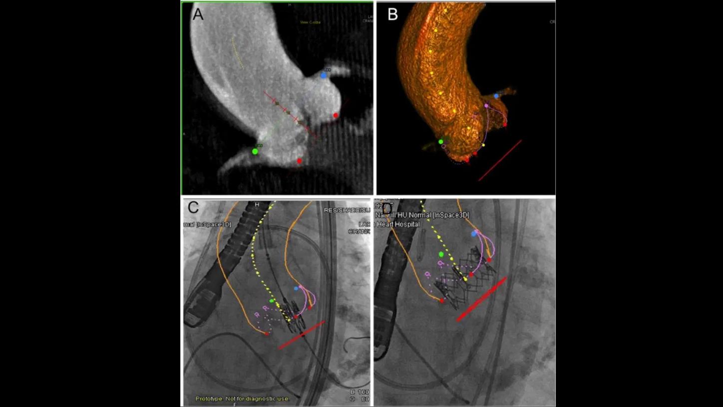 syngo Aortic Valve Guidance