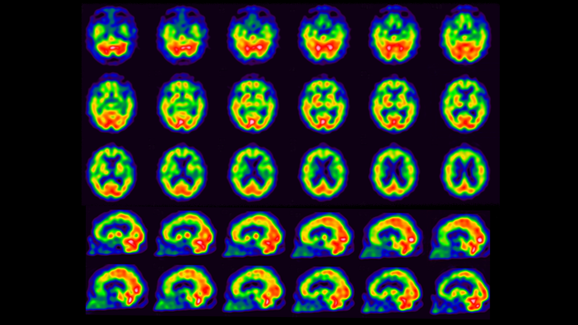 An examination of nuclear neurology in Japan - Siemens Healthineers