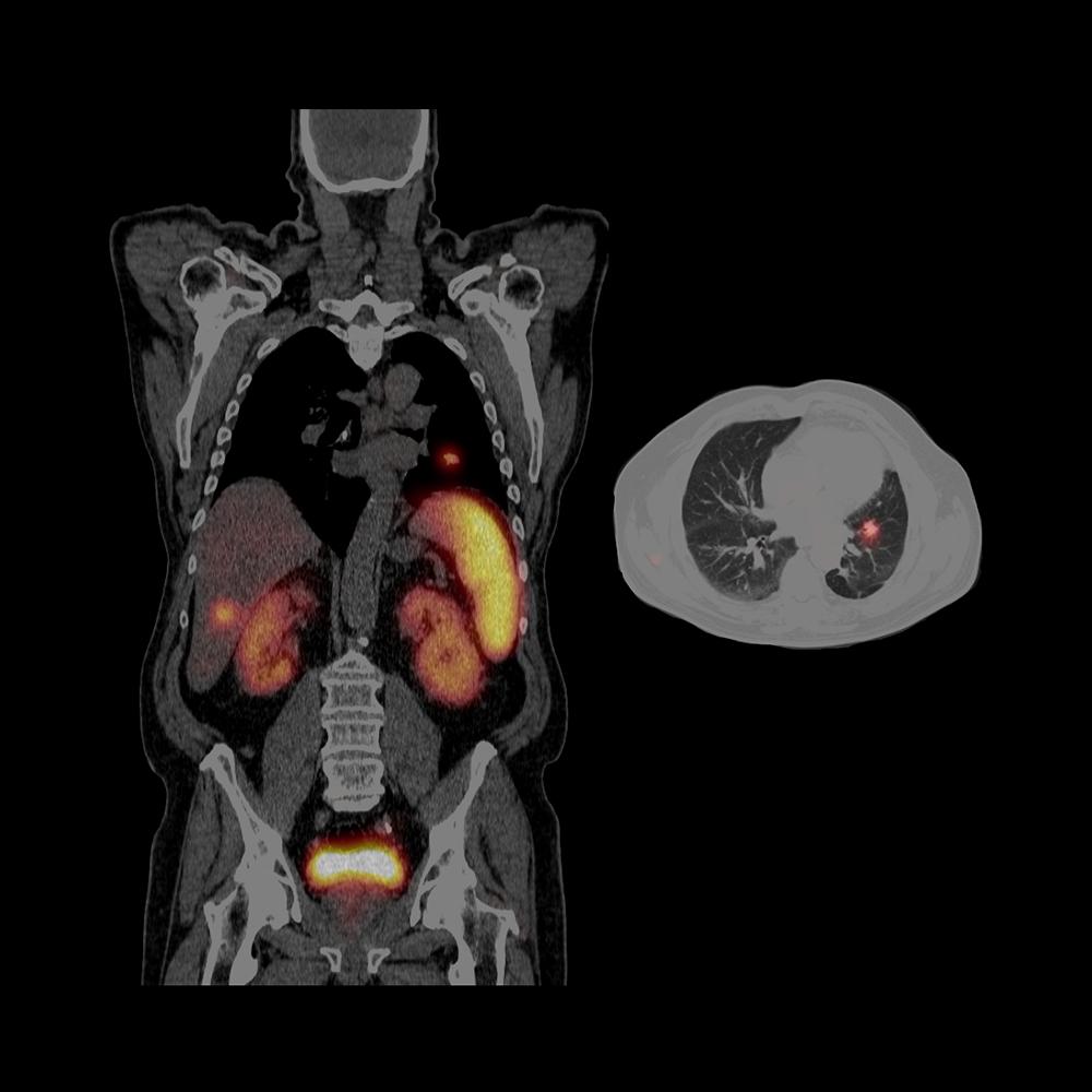 SPECT/CT assists in accurate localization of neuroendocrine tumor metastases