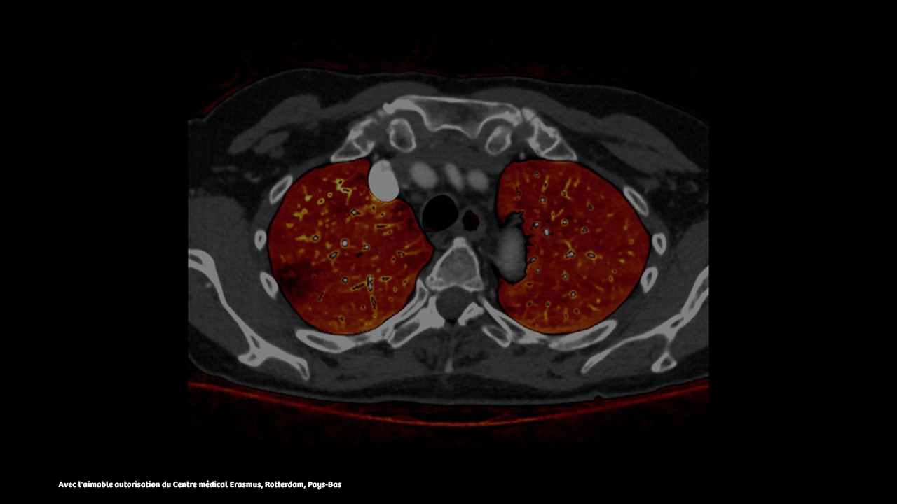Clinical cardiology image comparison of an EID-acquired computed tomography image and a spectral photon-counting computed tomography image of the lung, here you see the photon-counting CT image.