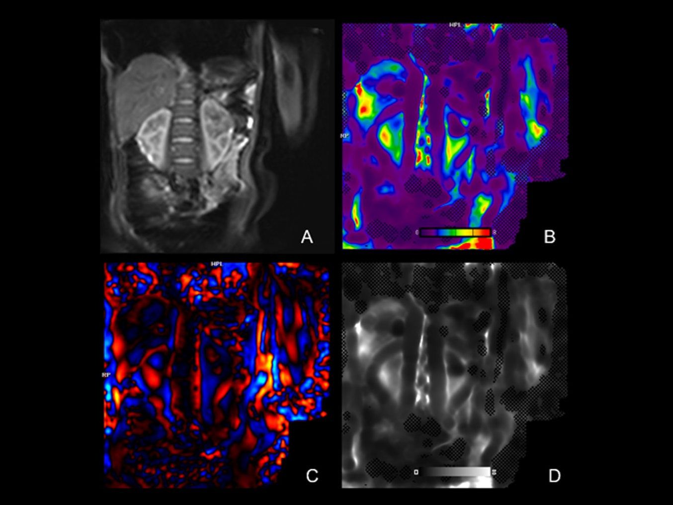 Pediatric Kidney MR Elastography