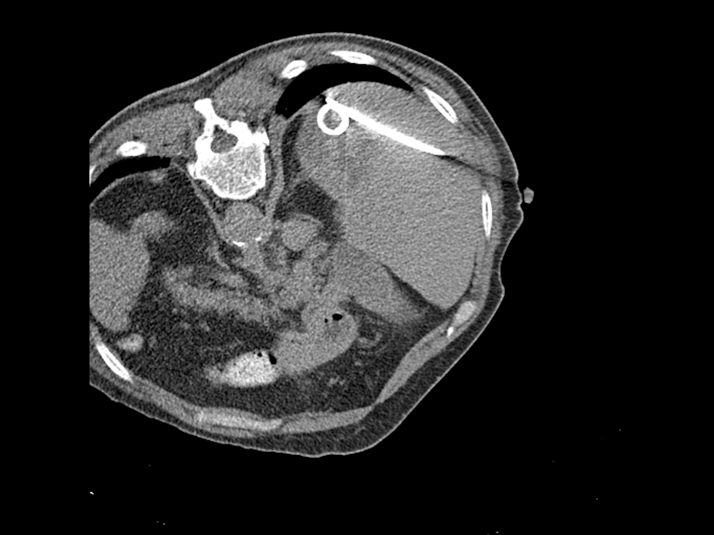 CT image-guided drainage placement in the liver using SOMATOM go.Top and myNeedle Guide; Axial view; i-Sequence