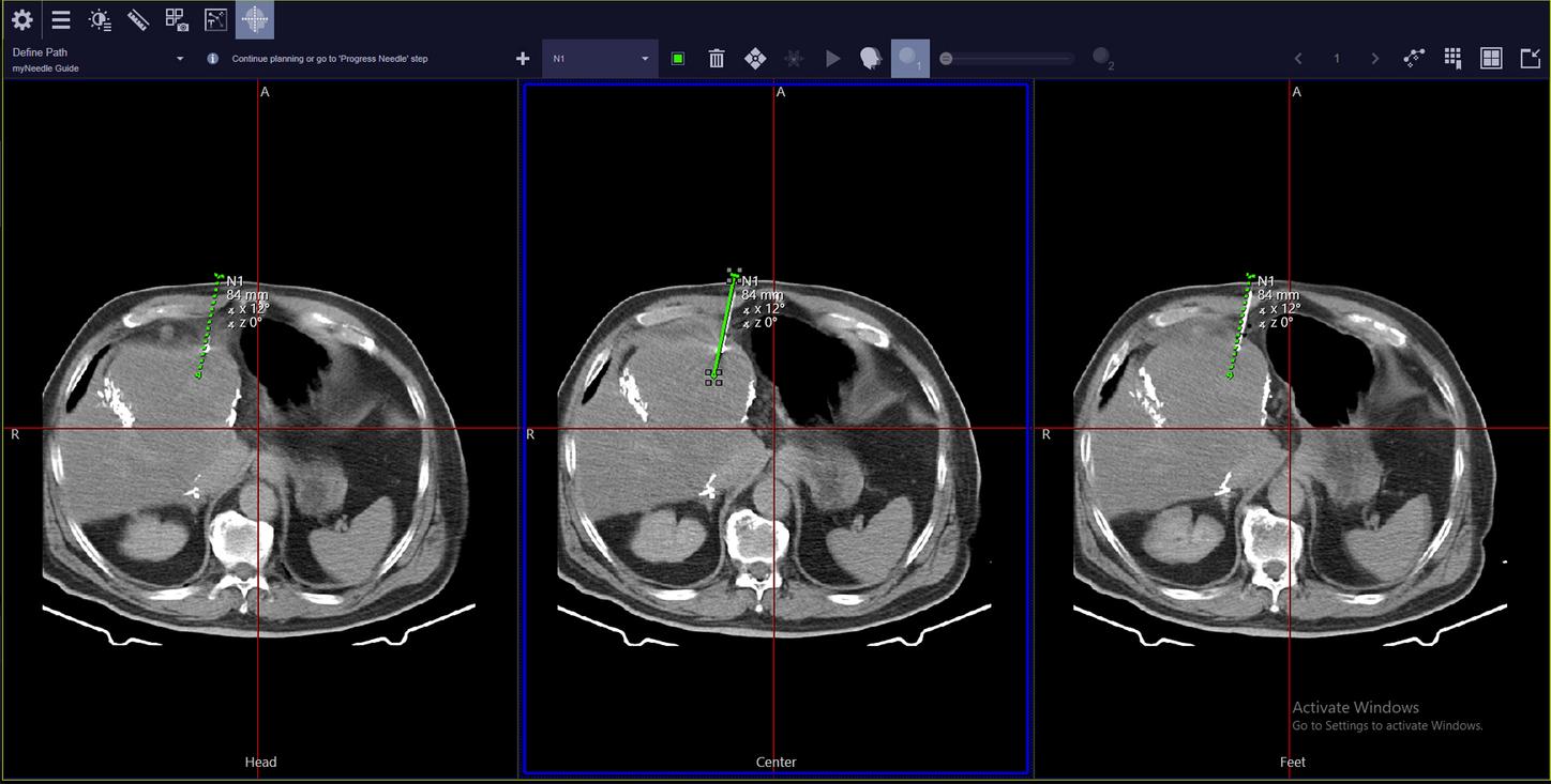 myNeedle Guide 2D with SOMATOM go.All