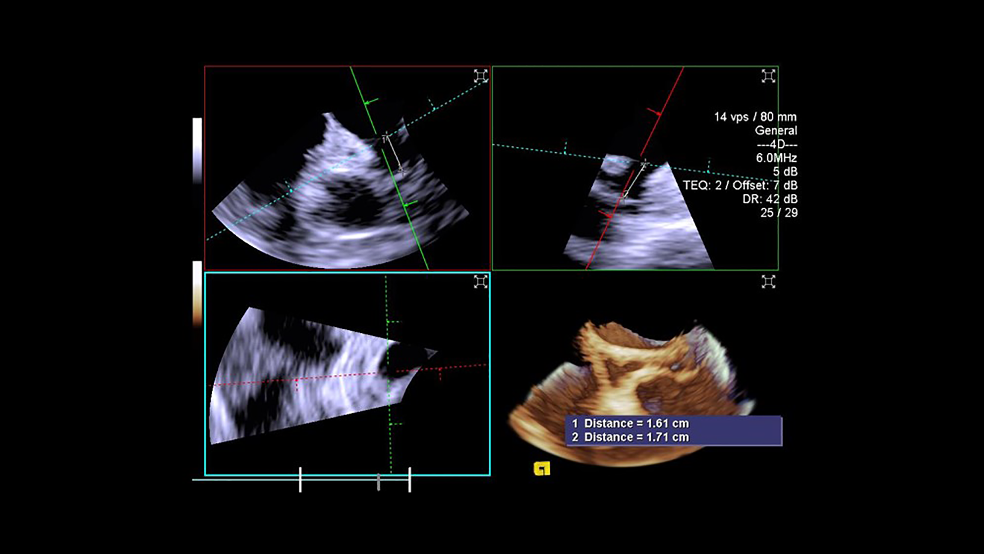 ACUSON AcuNav Volume ICE Catheter Siemens Healthineers USA