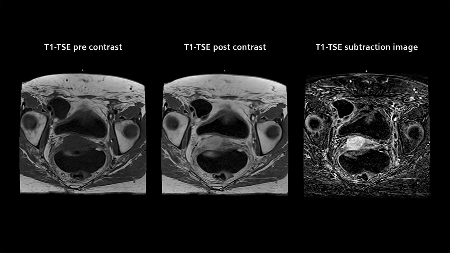 Advanced pelvic MR imaging clearly delineates gynecologic tumors