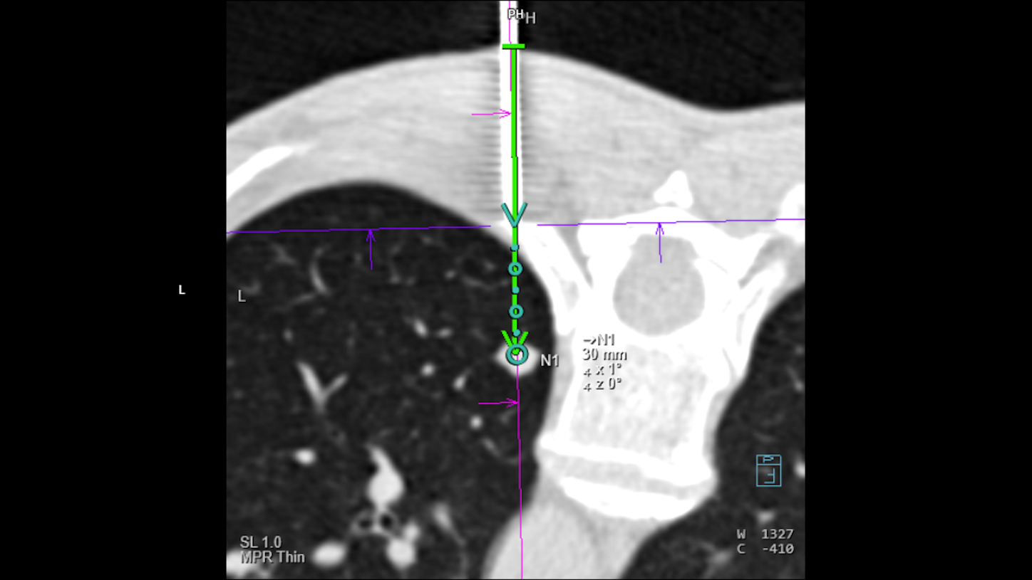 Cryoablation of an adrenal metastasis under CT guidance