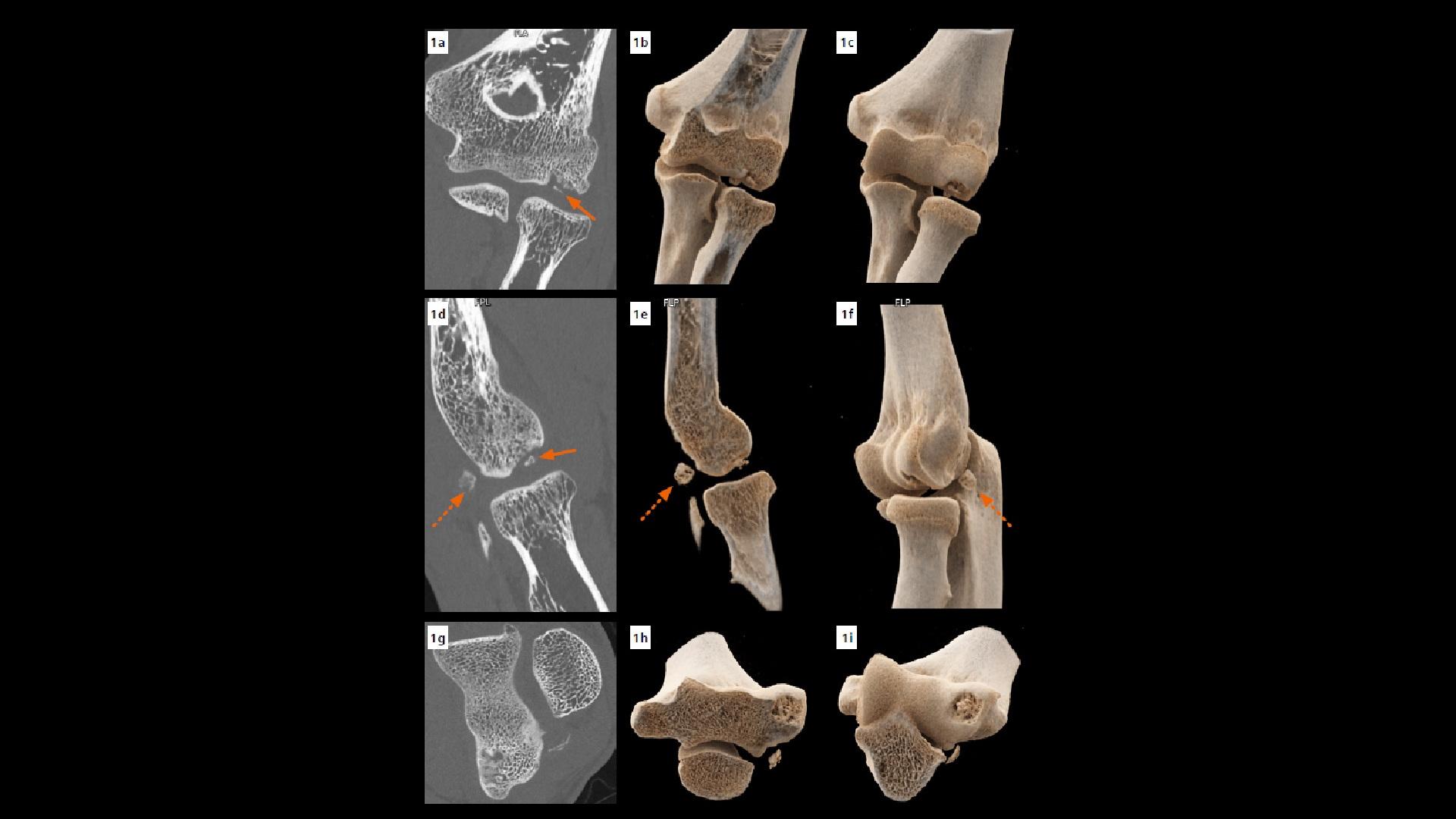 Osteochondritis Dissecans Of The Capitellum Siemens Healthineers Osteochondritis Dissecans Of The Capitellum Siemens Healthineers