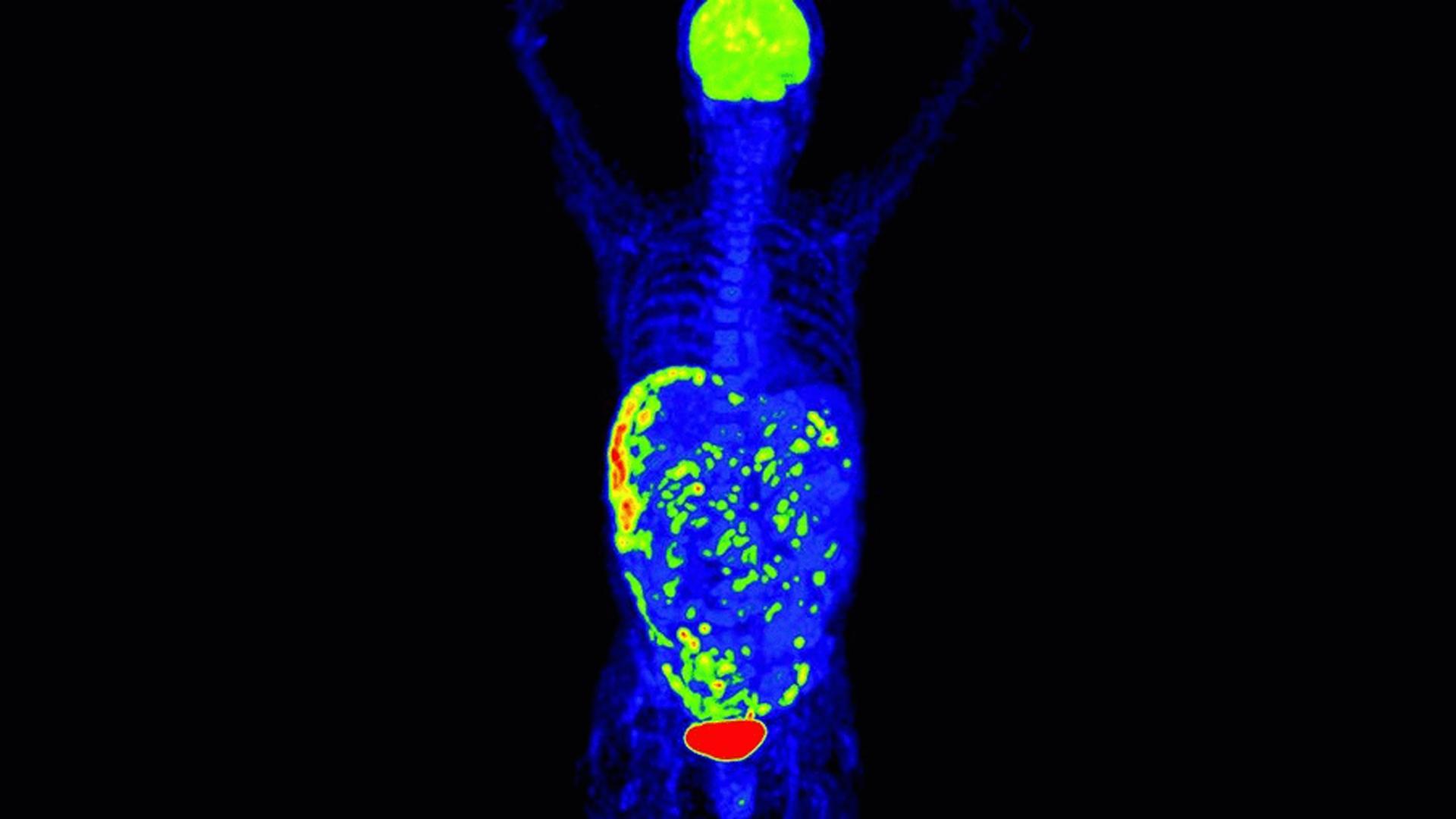 Digital LSO-based detector—Set the standard in PET/CT - Siemens ...