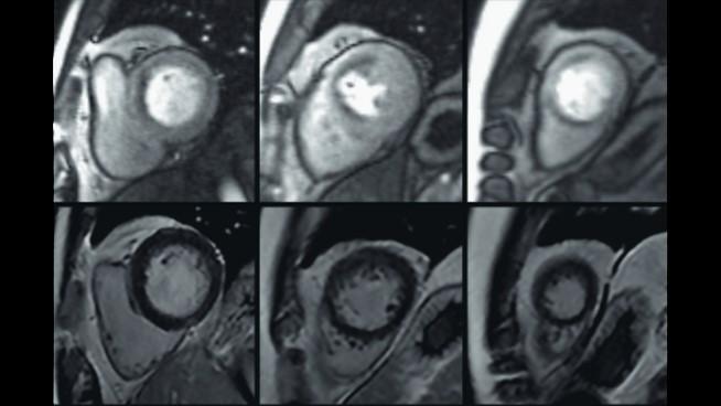 Compressed Sensing Cardiac Cine 