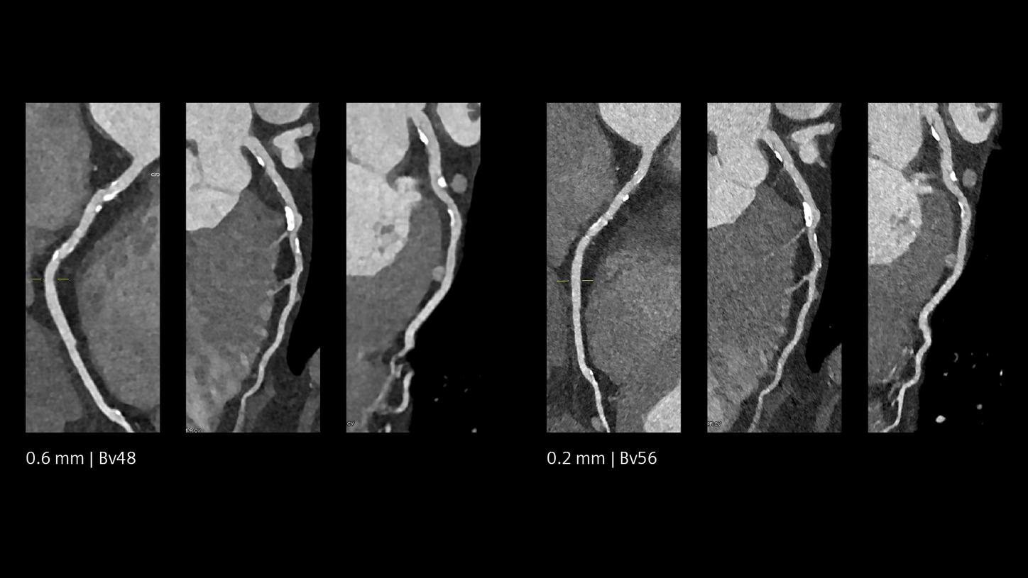 Clinical image comparison of 0.6 mm and 0.2 mm slice thickness in a Quantum HD Cardiac image, LAD, CX, and RCA view.