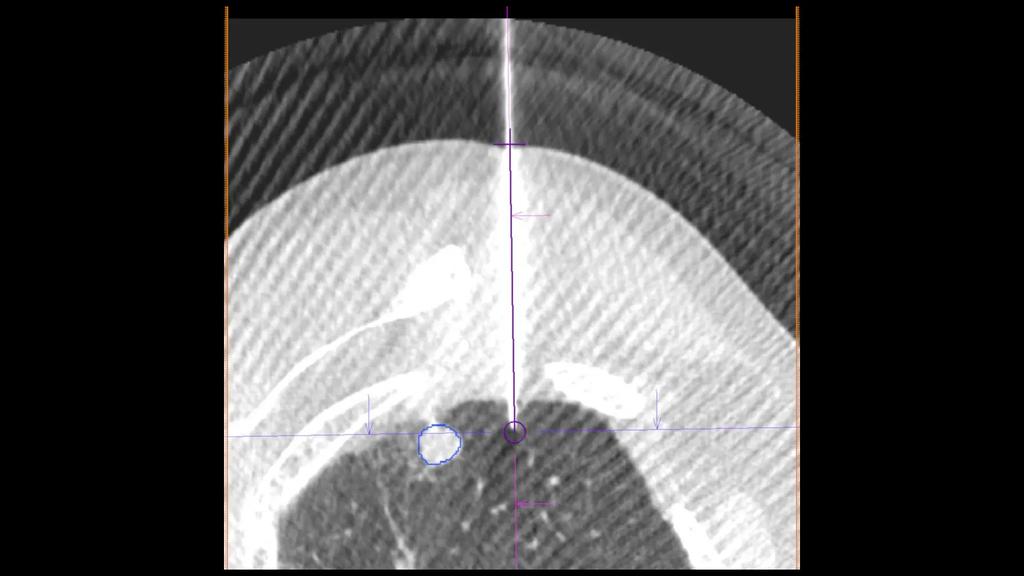 Diagnosis And Treatment Of Lung Cancer - Siemens Healthineers