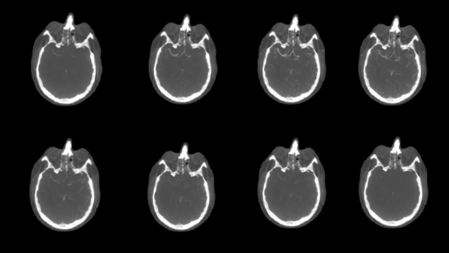 Visualización de vasos colaterales para trombectomía en ACV