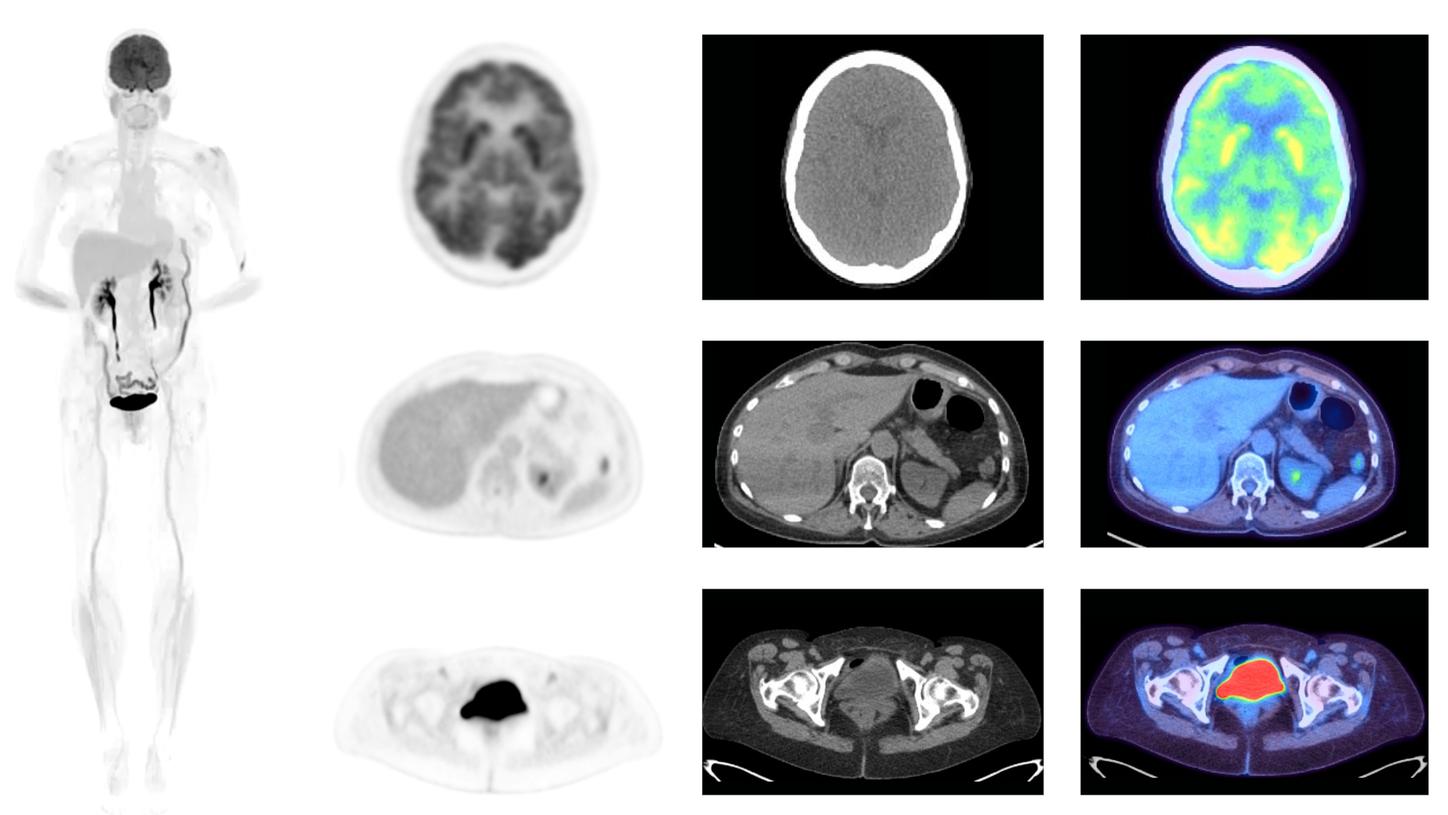 Full-body PET image acquired with the Biograph Vision Quadra PET/CT