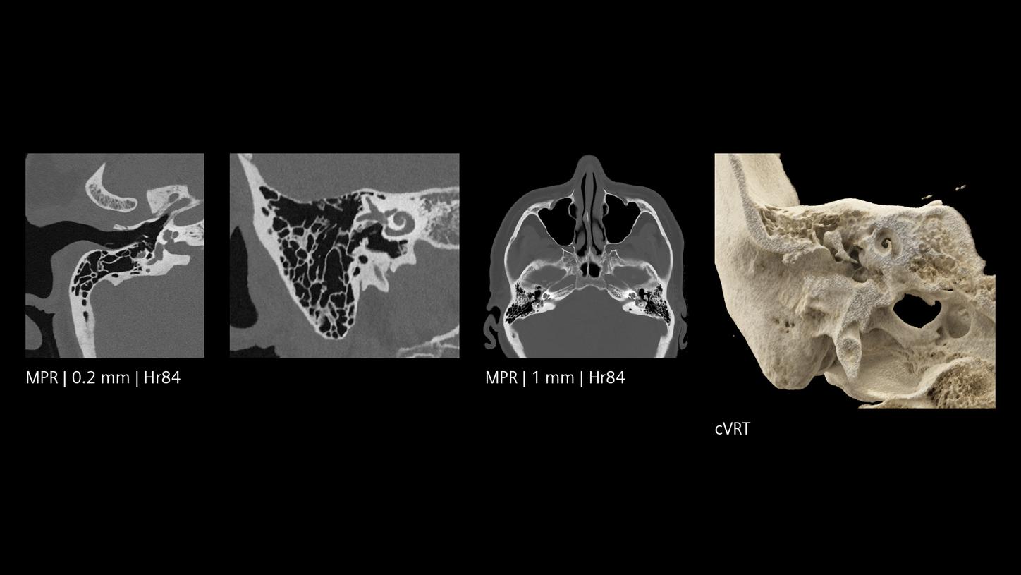 High-resolution CT images of the temporal bone and inner ear, including a 3D rendering of the skull base.